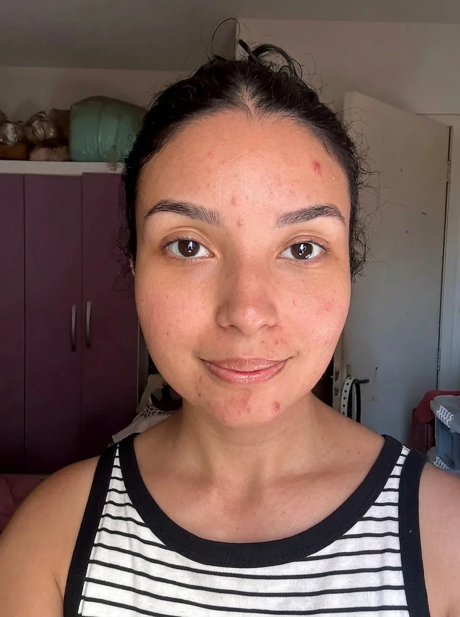 Antes — pele com manchas e marcas de acne